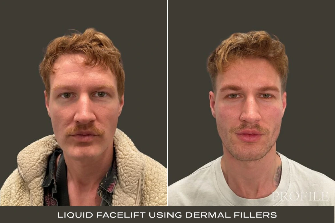 Before and after comparison labeled 'Liquid Facelift Using Dermal Fillers' showing man's face from two angles