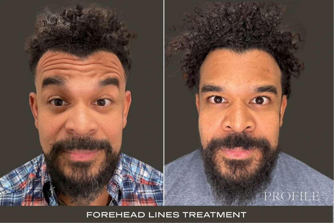 Before and after comparison of man's forehead showing reduction of forehead lines after treatment