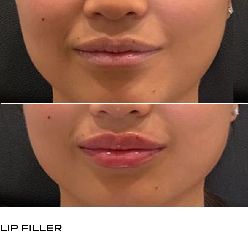 Before and after comparison of fuller lips from lip filler treatment