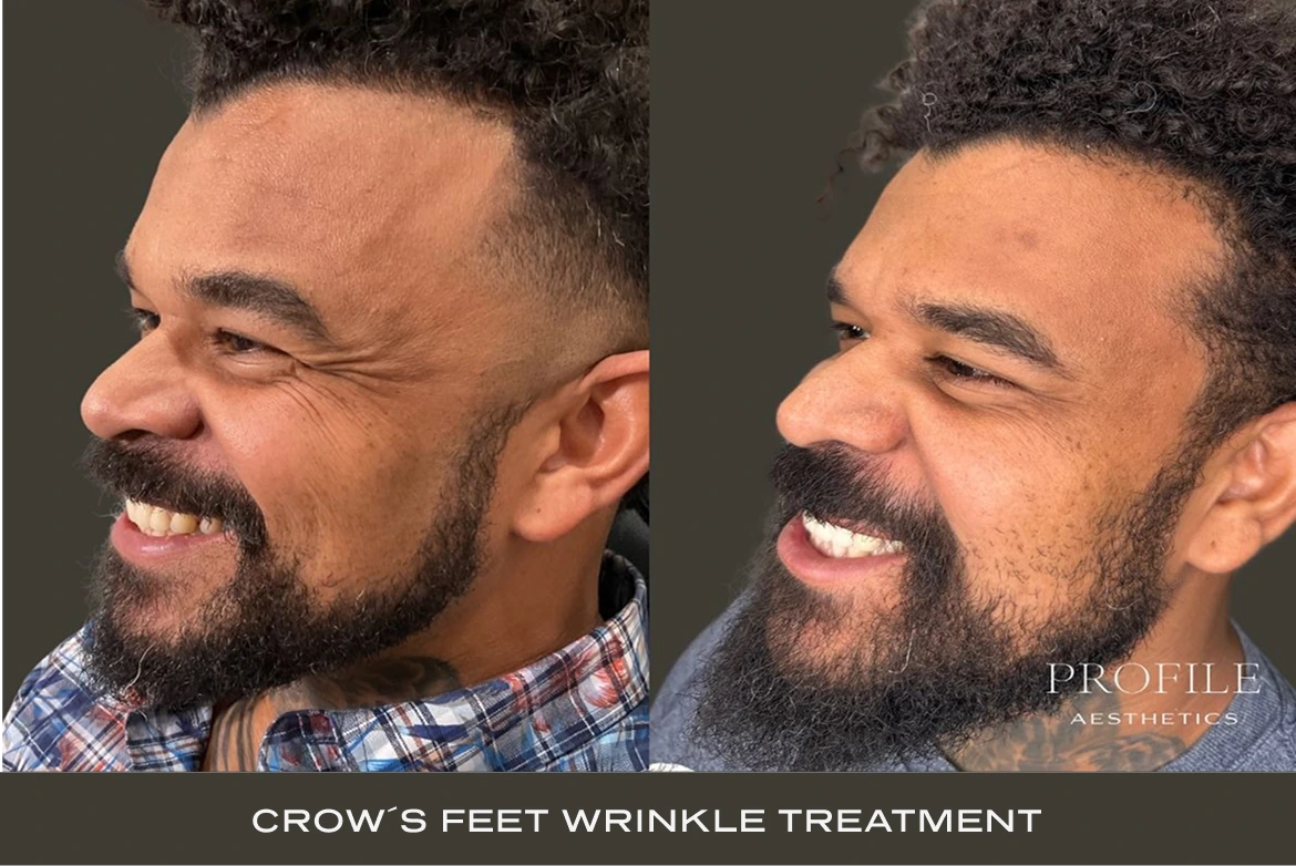 Before and after side profile comparison of male patient showing reduced crow's feet wrinkles from treatment