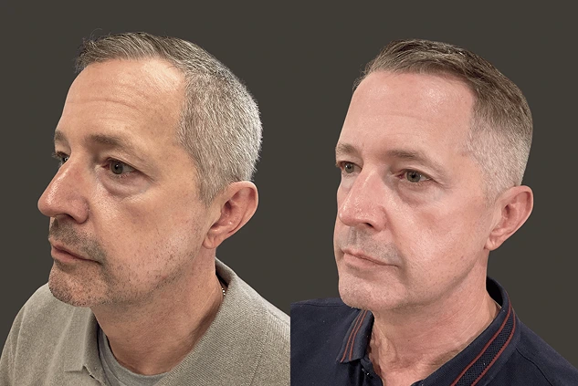 Before and after profile views of male patient showing skin texture improvement from microneedling treatment