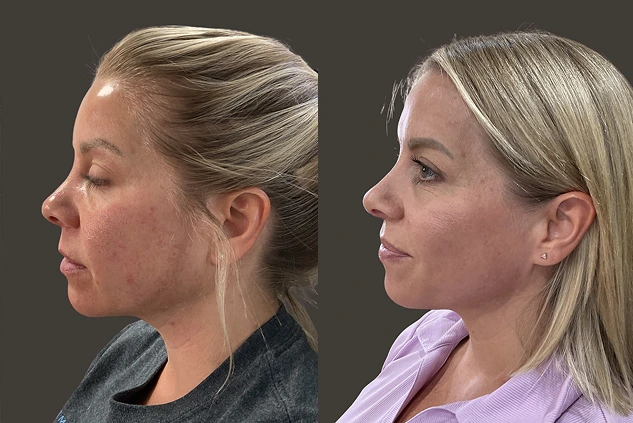 Before and after profile view comparison: left shows woman with visible skin texture and sagging, right shows same woman with improved skin texture and lifted appearance