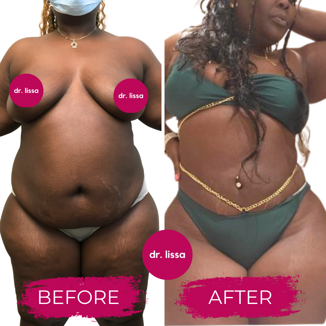 Before and after full-body view showing results of liposuction and body contouring procedure
