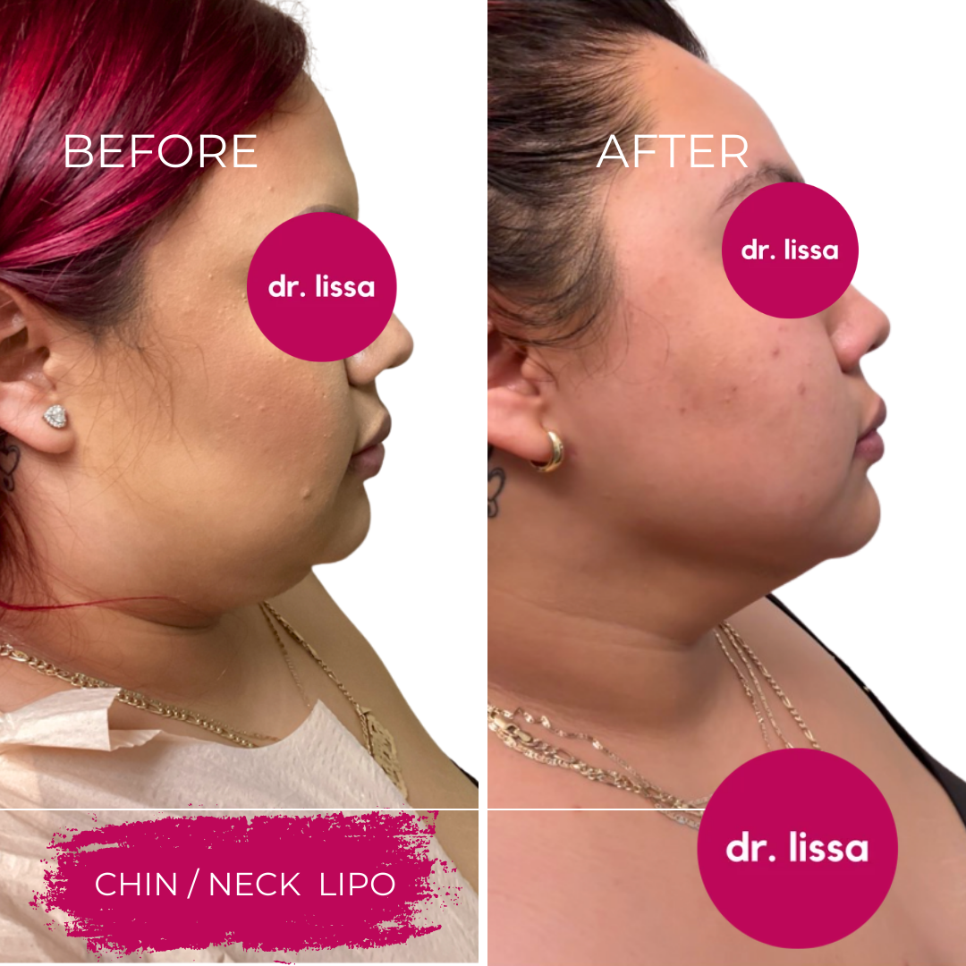 Before and after chin and neck liposuction results showing profile improvement