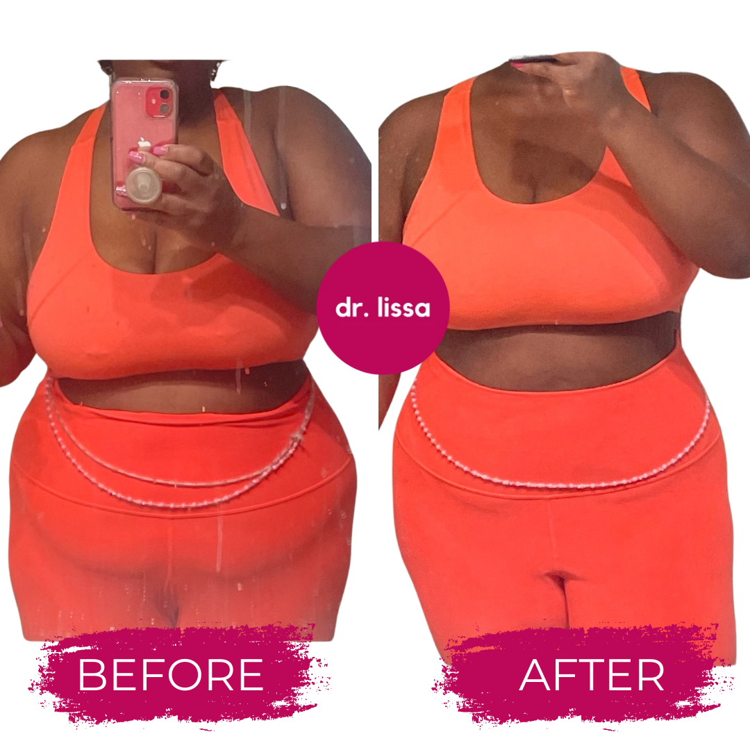 Before and after liposuction results showing abdominal and waist contouring with surgical markings visible