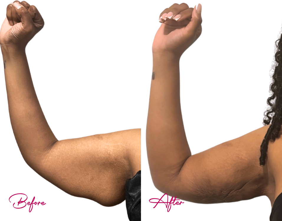Before and after arm liposuction showing reduced arm fullness with flexed biceps