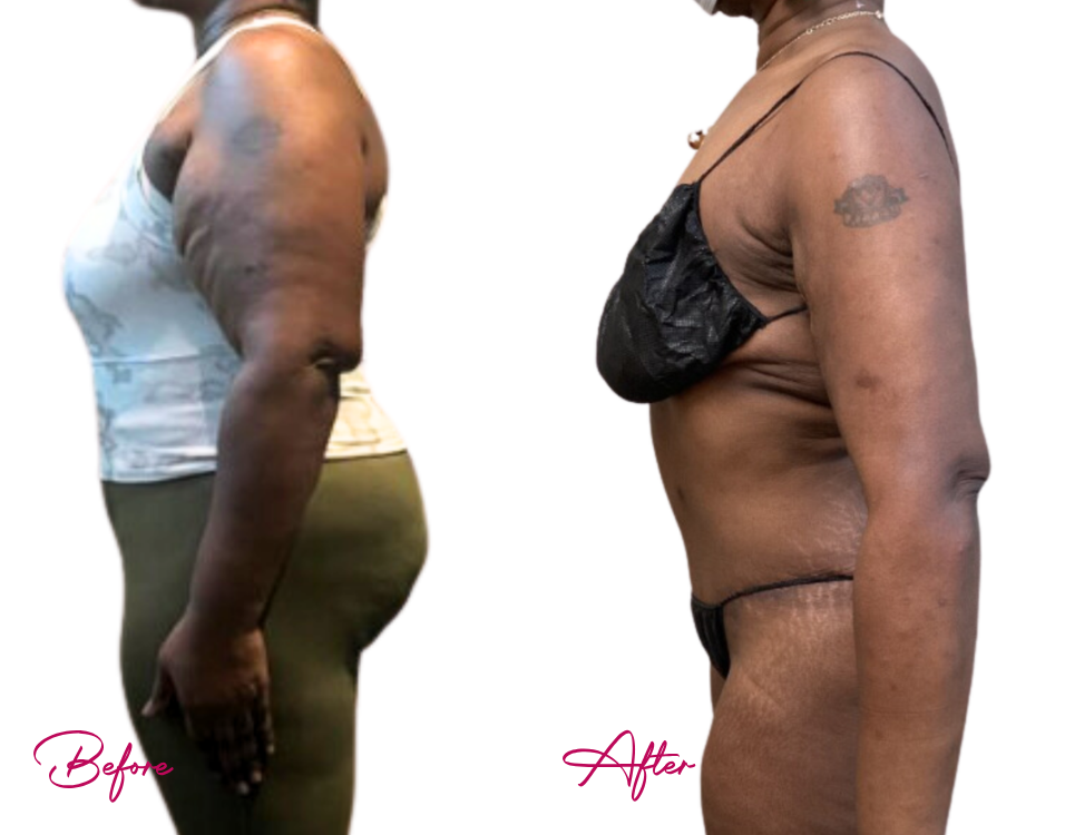 Before and after arm and torso liposuction showing slimmer arms and improved body contour