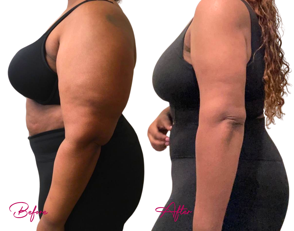Before and after arm liposuction showing reduced arm fullness and improved muscle definition