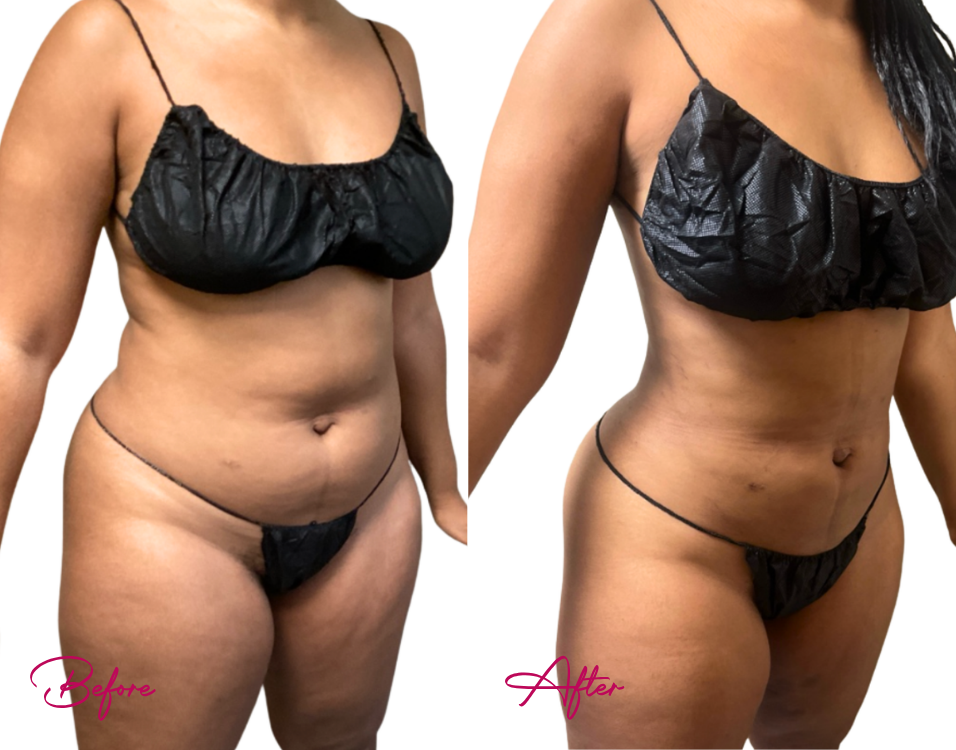 Before and after AWAKE Lipo showing reduced abdominal and torso fullness