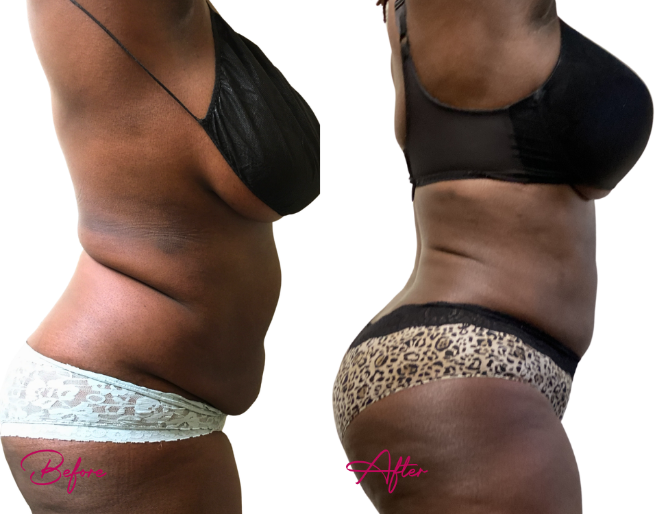 Before and after AWAKE Lipo showing reduced abdominal and flank fullness