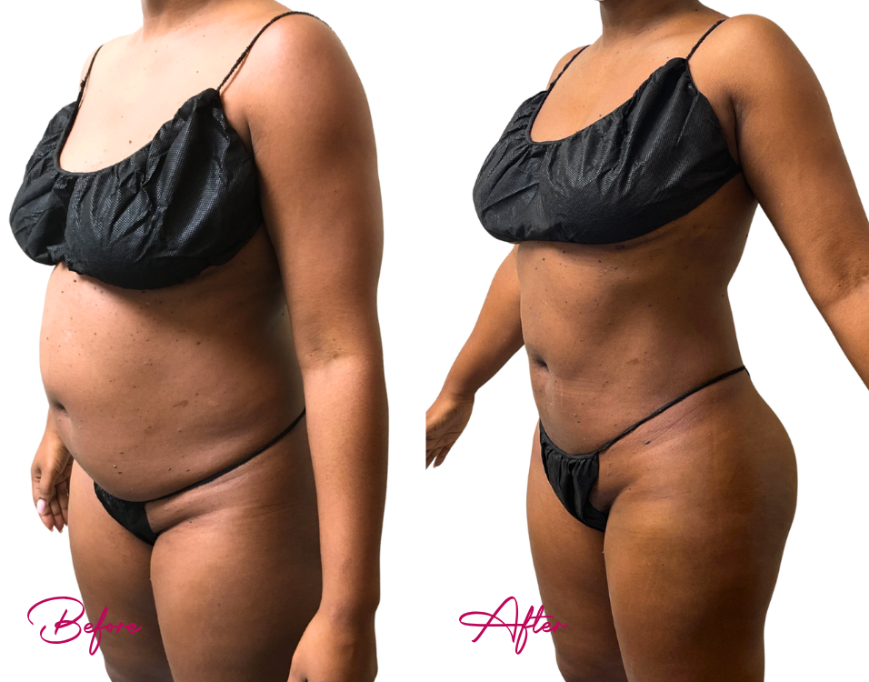 Before and after awake liposuction showing reduced abdominal and torso fullness