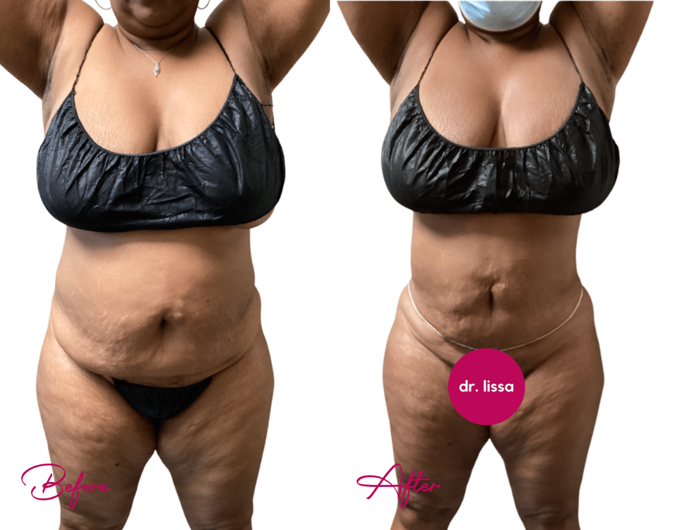 Before and after AWAKE Lipo Case 21 showing frontal torso view with abdominal contouring