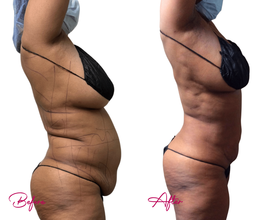 Before and after AWAKE Lipo Case 22 showing side profile of abdomen and torso