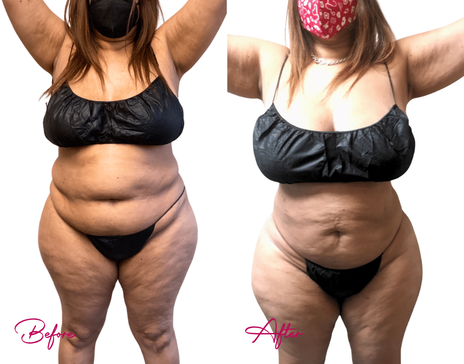 Before and after AWAKE Lipo Case 23 showing frontal torso and abdominal definition