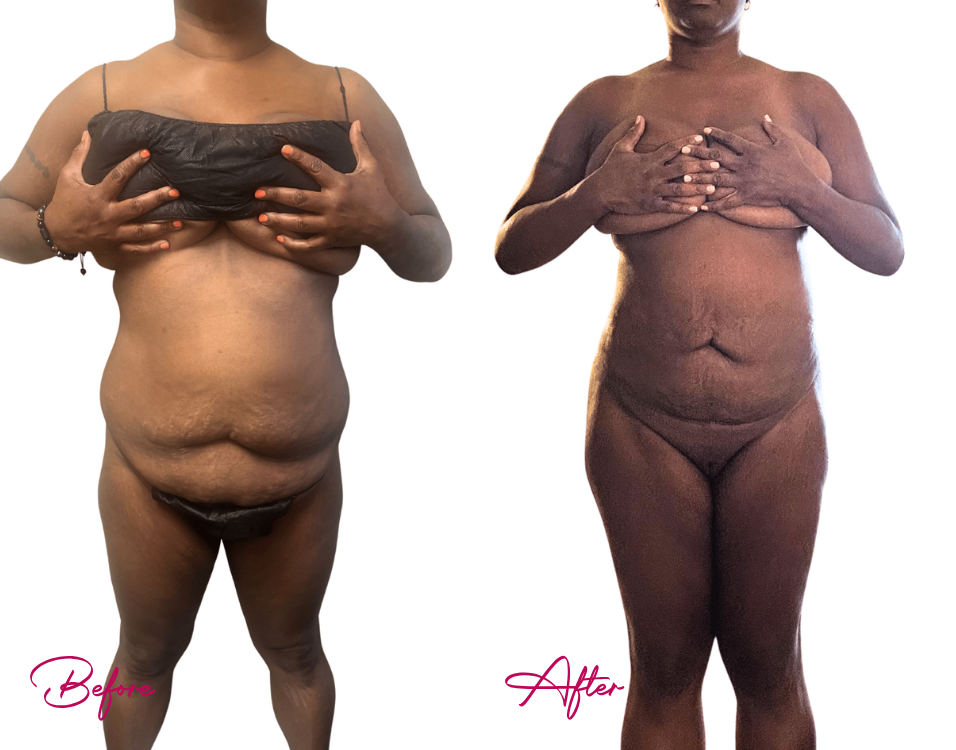Before and after AWAKE Lipo Case 24 showing frontal full torso contour improvement