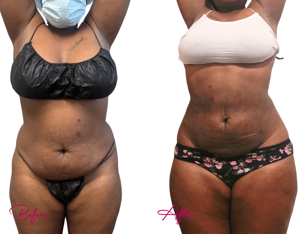 Before and after AWAKE Lipo Case 25 showing frontal torso with abdominal and flank refinement