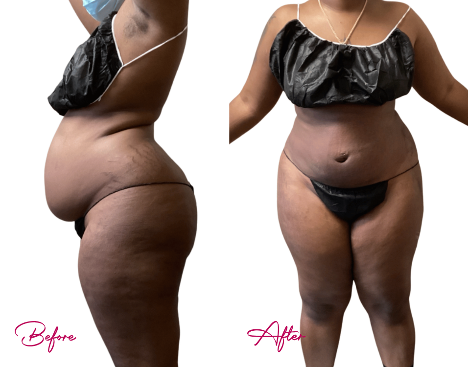 Before and after AWAKE Lipo Case 26: side-by-side comparison showing reduced abdominal and hip contours