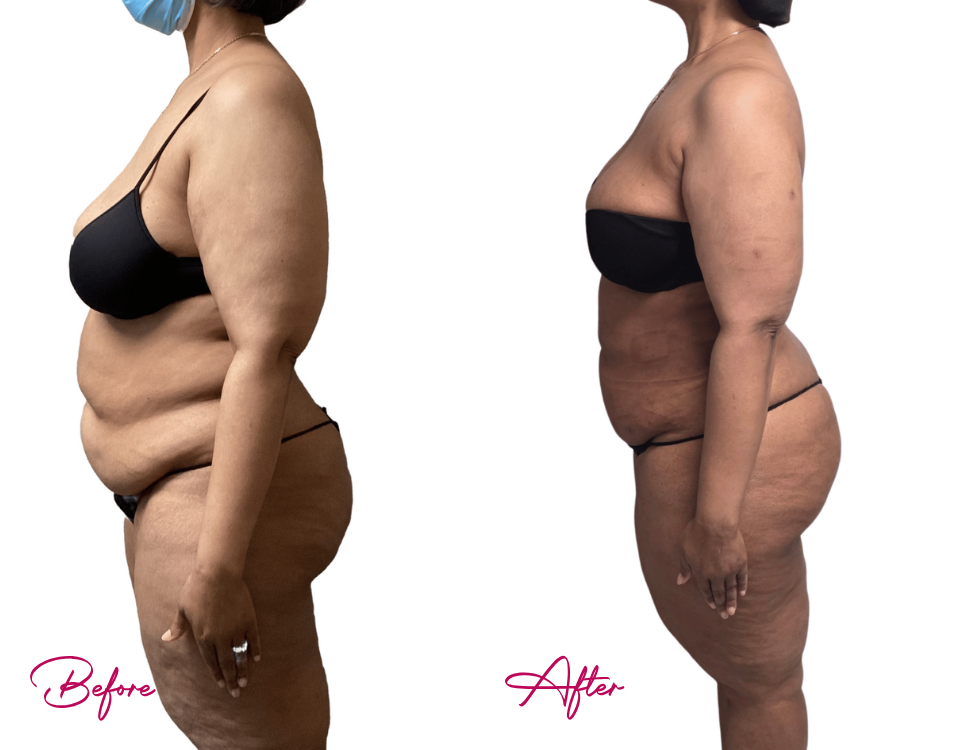Before and after AWAKE Lipo Case 27: side profile comparison showing reduced midsection and abdominal contours