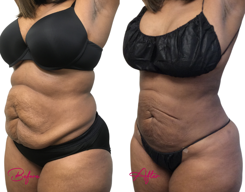 Before and after AWAKE Lipo Case 28 showing abdominal contouring results from side view