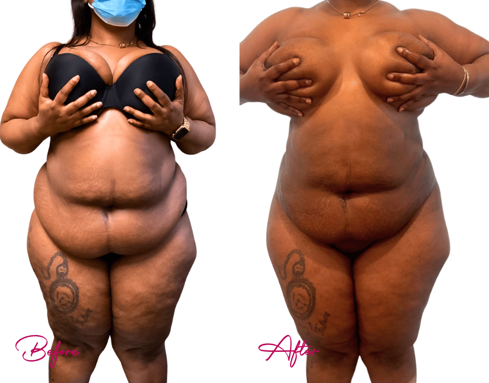 Before and after AWAKE Lipo Case 29: front view comparison showing reduced abdominal and upper body contours