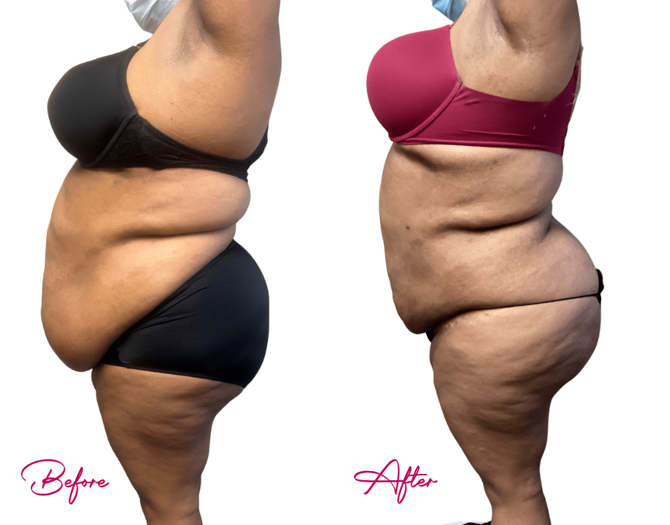 Before and after AWAKE Lipo Case 30: side profile comparison showing reduced abdominal and hip contours