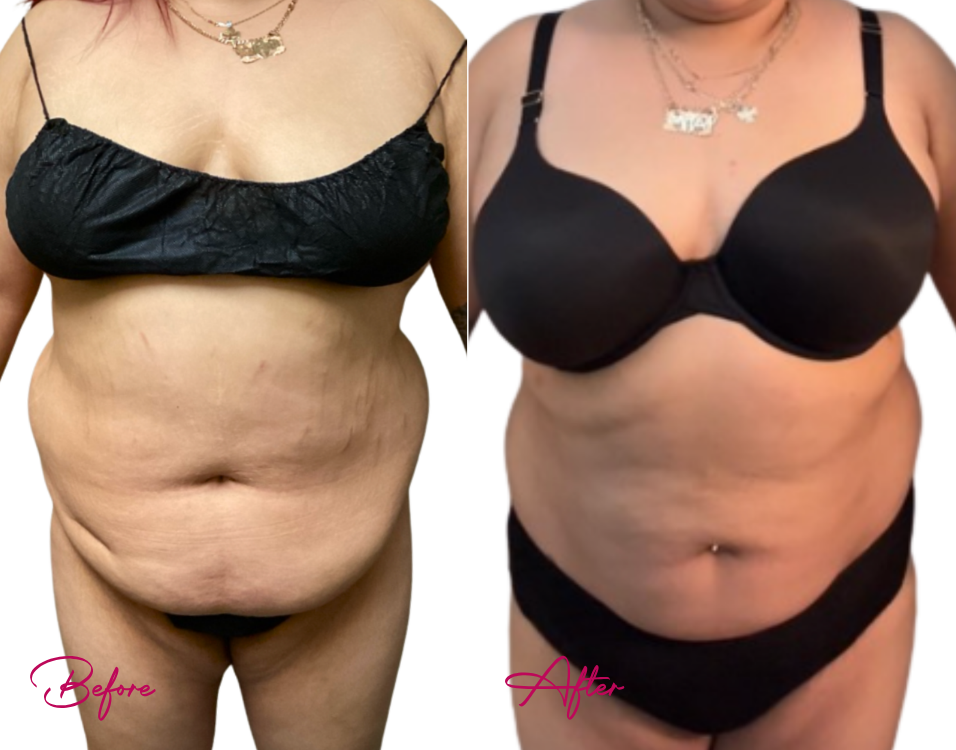 Before and after AWAKE Lipo Case 32 showing torso and abdominal sculpting results from front view