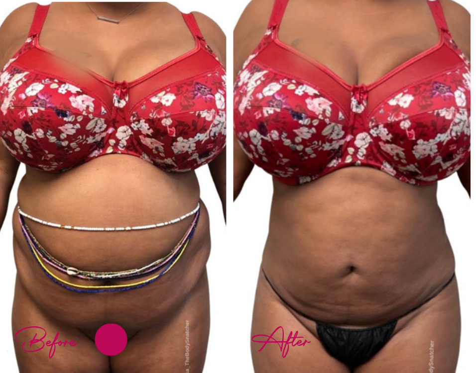 Before and after AWAKE Lipo Case 33 showing waist and abdominal contouring from front view