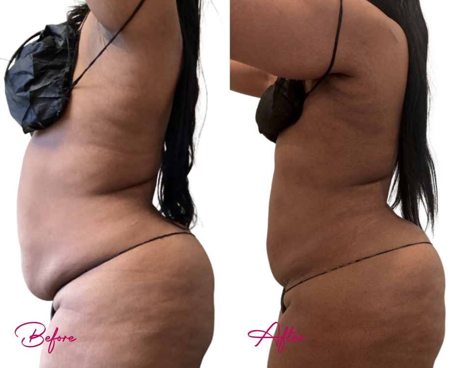 Before and after AWAKE Lipo Case 34 showing side profile body contouring results