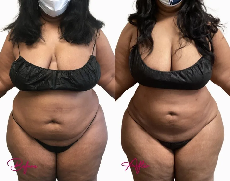 awake-liposuction-case-3 awake-liposuction-case-3
