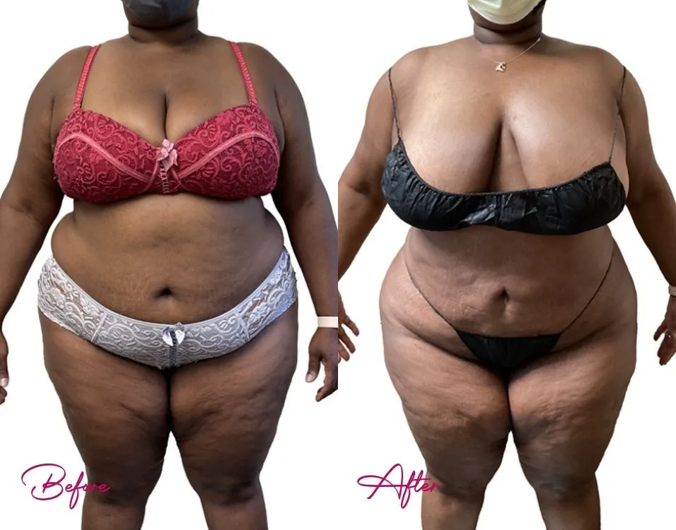 awake-liposuction-case-4 awake-liposuction-case-4