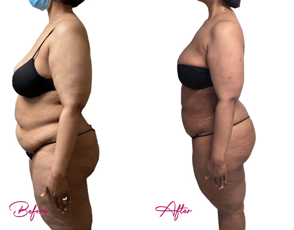 Before and after high BMI body contouring results showing side view