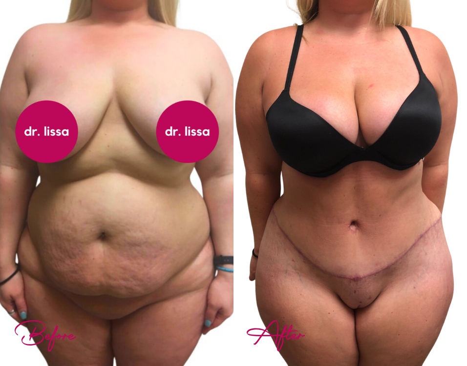 Before and after tummy tuck procedure with improved abdominal contour and reduced skin laxity