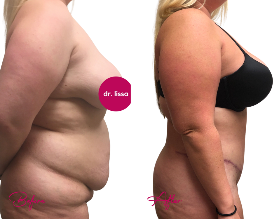 Before and after breast augmentation side profile comparison showing enhanced breast shape and volume
