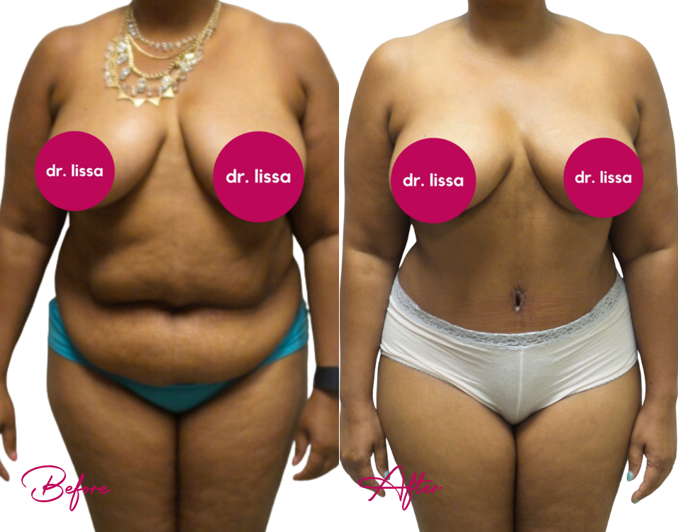 Before and after tummy tuck showing flatter abdomen, improved waistline, and reduced skin excess