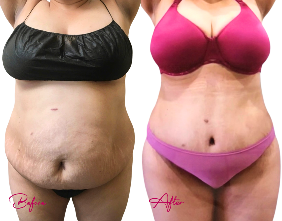 Before and after tummy tuck comparison showing reduced abdominal laxity and improved contour