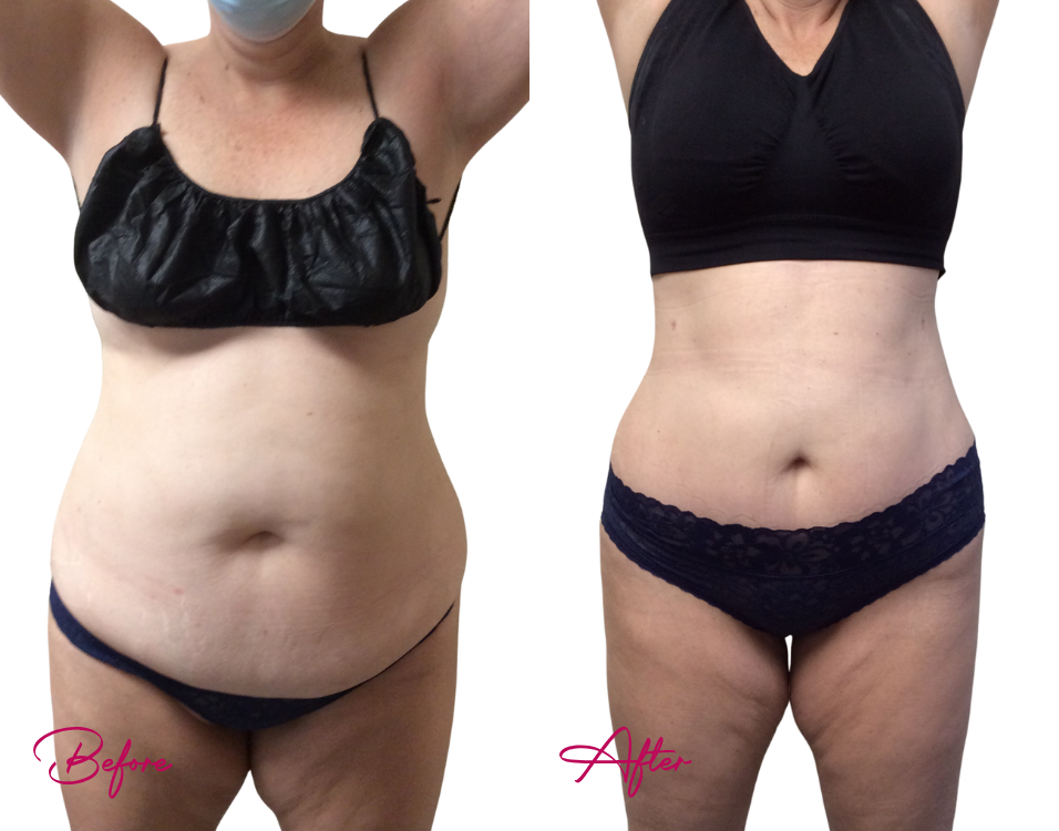 Before and after tummy tuck case showing flattened abdomen and tightened midsection