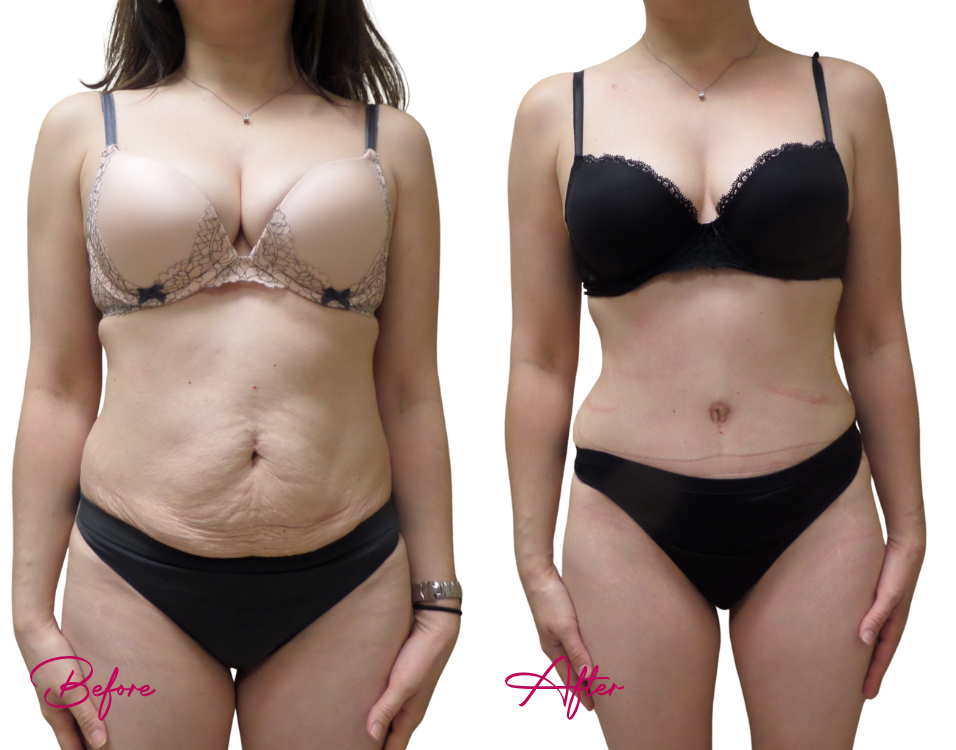 Before and after tummy tuck with improved abdominal skin texture and defined waistline