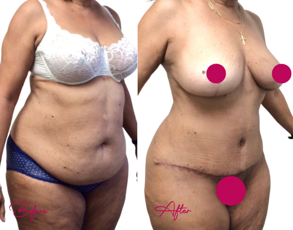 Before and after cosmetic surgery case showing body contouring results