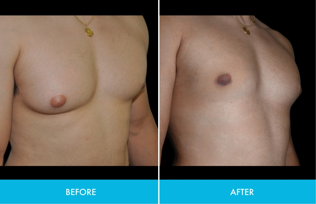 Before and after comparison of male chest, labeled before on left and after on right