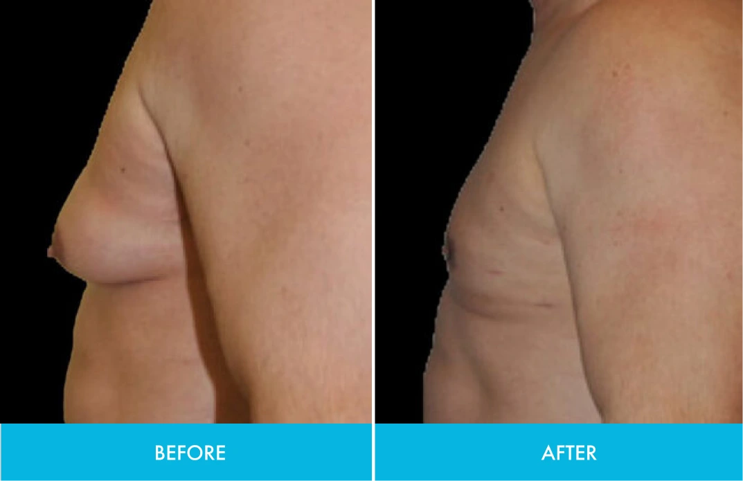 Before and after side profile comparison showing chest contour changes