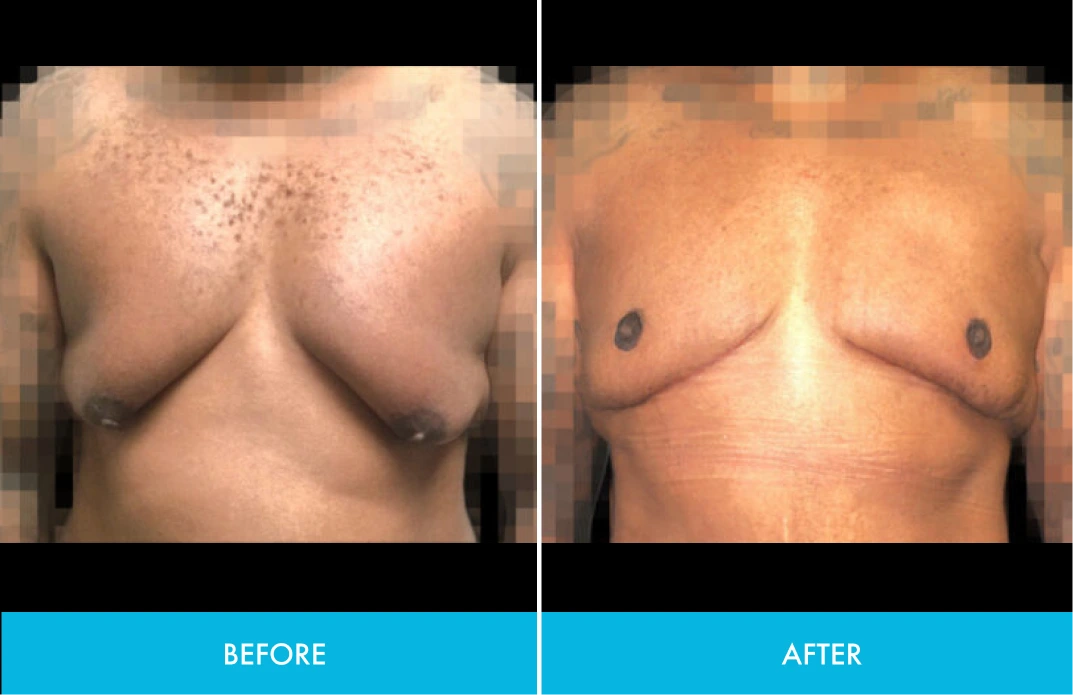Before and after chest comparison showing contour refinement