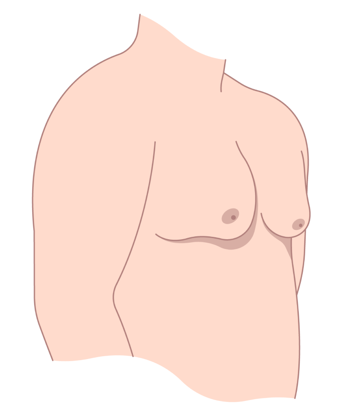 Front illustration of female torso showing breast anatomy