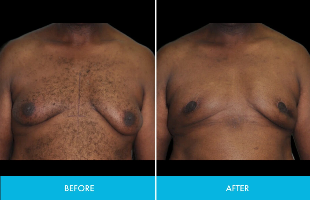 Before and after chest comparison showing skin smoothness improvement