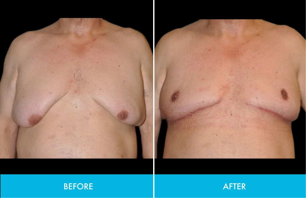 Before and after chest comparison showing tissue contouring results