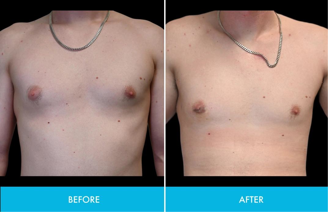 Before and after chest comparison showing skin texture improvement