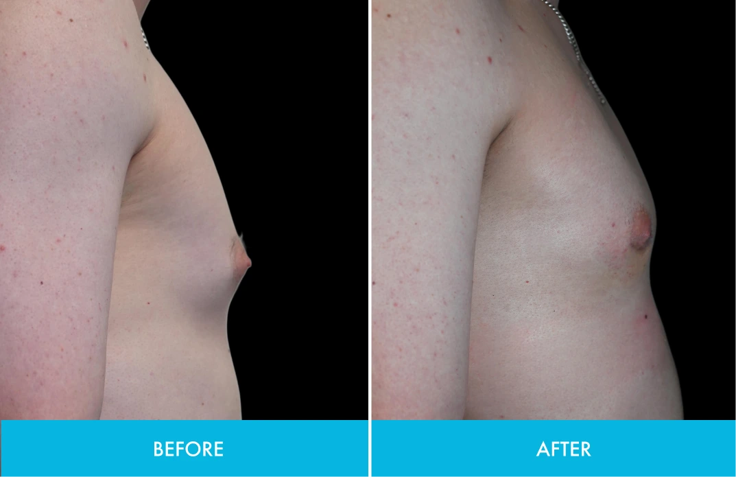 Before and after side-view chest comparison