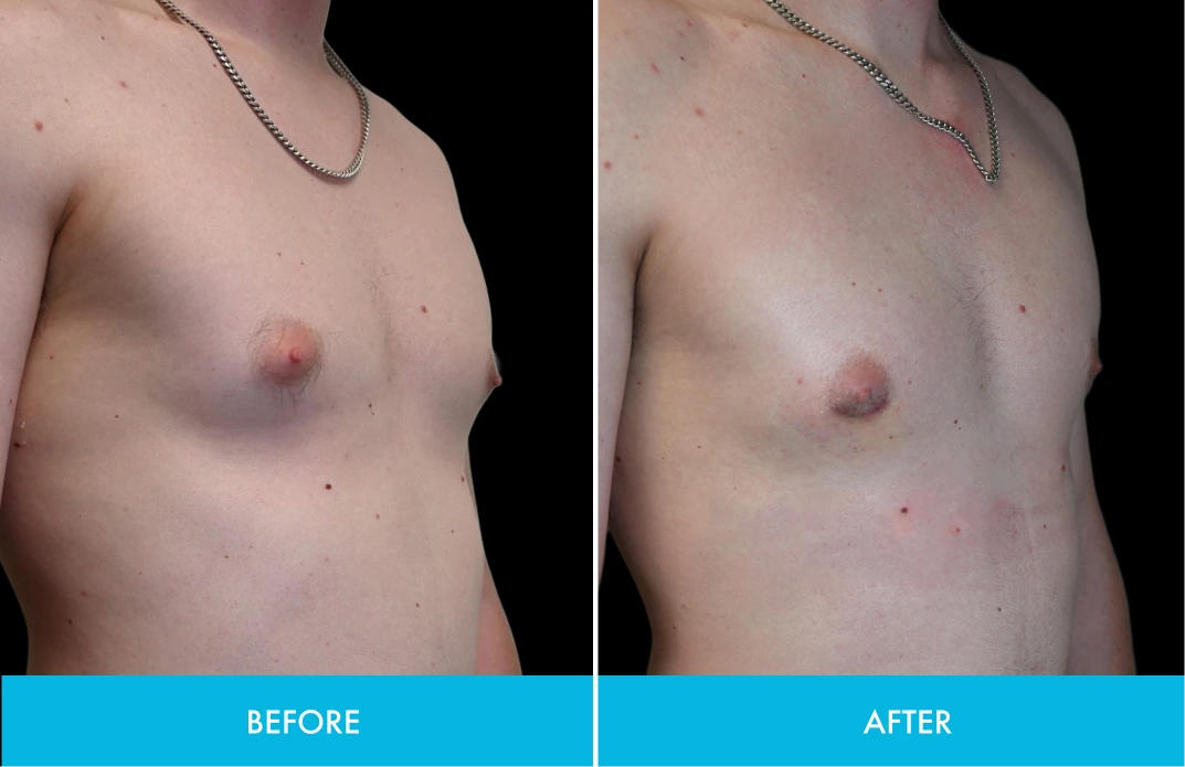 Before and after side-view chest comparison