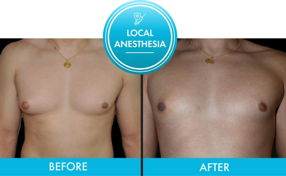 Before and after chest comparison with Local Anesthesia label
