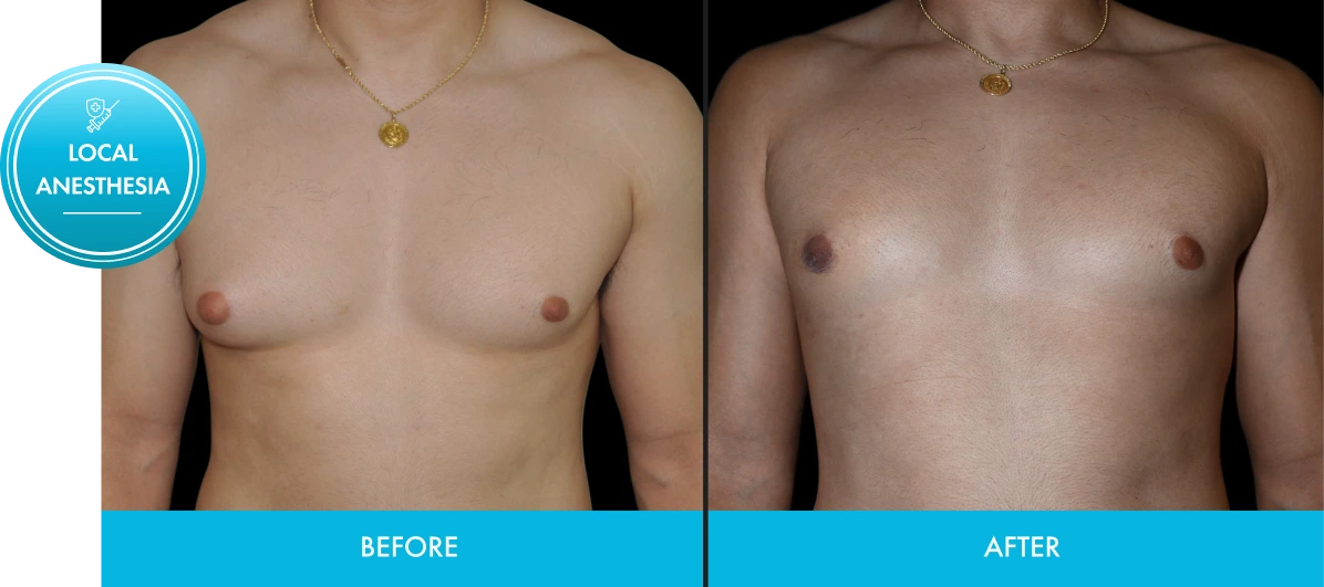 Before and after chest comparison with Local Anesthesia badge