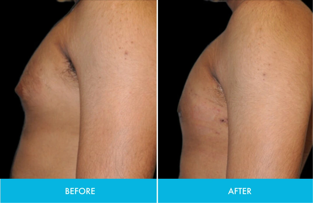 Before and after side profile comparison showing body contour results